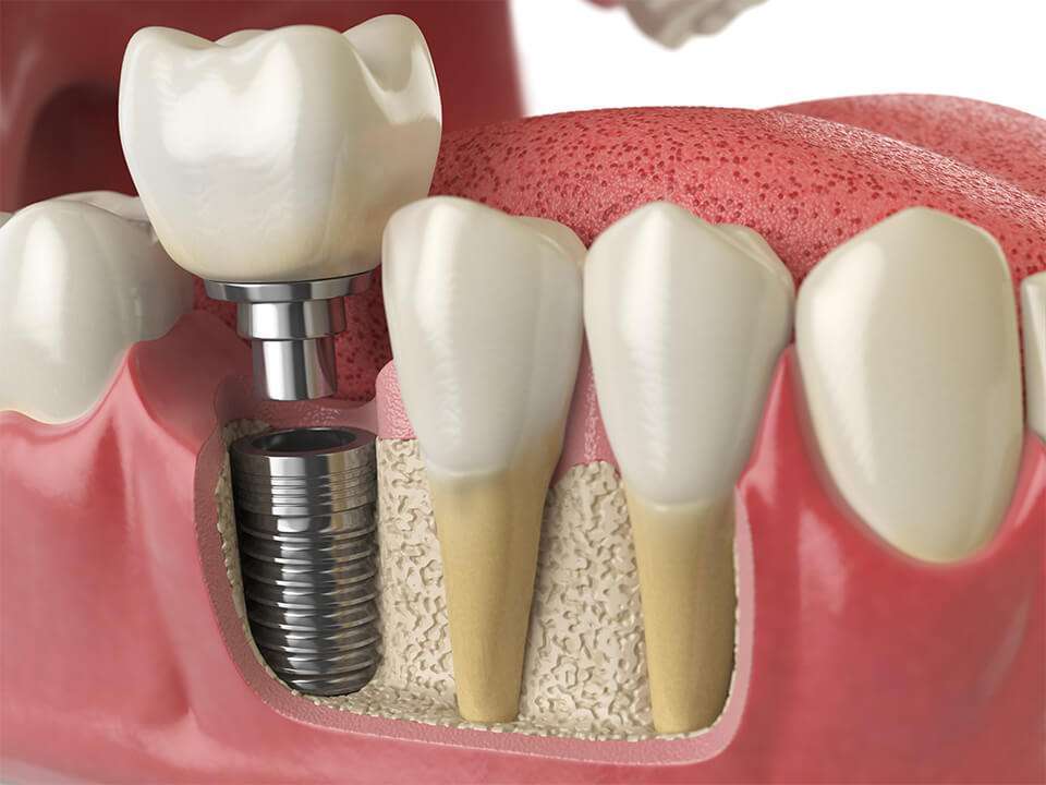 Dentiste à Paris 8 pour édentement dentaire